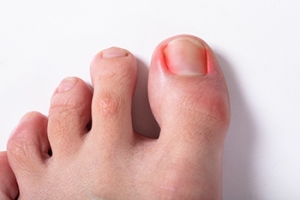 Defining an Ingrown Toenail