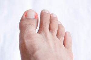 Treatment for Ingrown Toenails