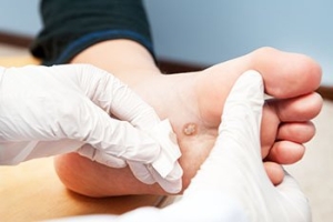 What Is a Plantar Wart?