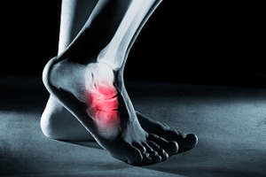 Who Is Prone to Cuboid Syndrome?