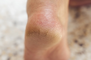 Common Reasons Why Cracked Heels Develop