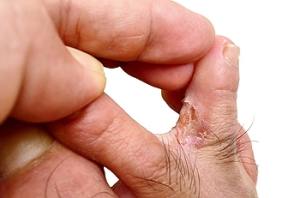 Uncomfortable Athlete’s Foot