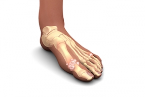 Facts About Managing Gout