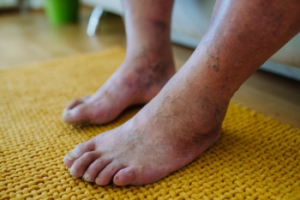 Education on Diabetic Foot Care