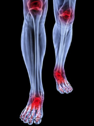 What Is Juvenile Arthritis?